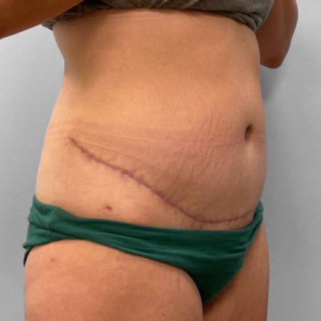 After image 2 Case #120861 - Abdominoplasty & Liposuction