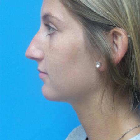 Before image 3 Case #121321 -   Open Rhinoplasty - 2 year post-op