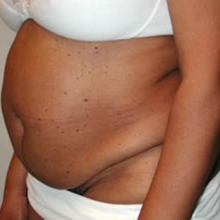 Before image 2 Case #122006 - Mommy Makeover Tummy Tuck