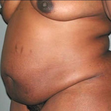 Before image 1 Case #122011 - Mommy Makeover Tummy Tuck 