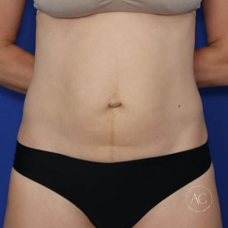 Before image 1 Case #122076 - Abdominoplasty