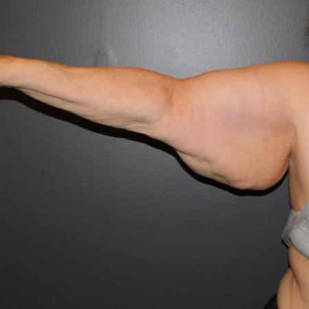 Before image 2 Case #122361 - Brachioplasty with liposuction