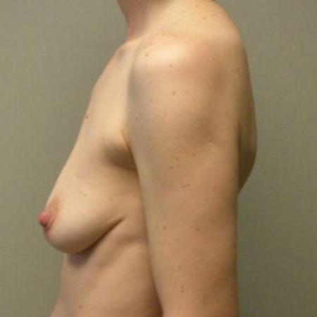 Before image 3 Case #121976 - Breast Augmentation Silicone 