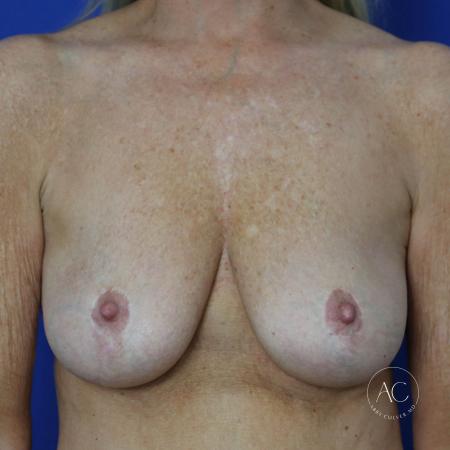 Before image 1 Case #122086 - Mastopexy