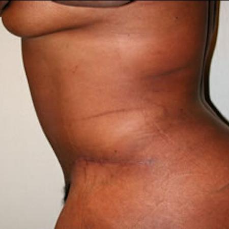 After image 2 Case #122011 - Mommy Makeover Tummy Tuck 