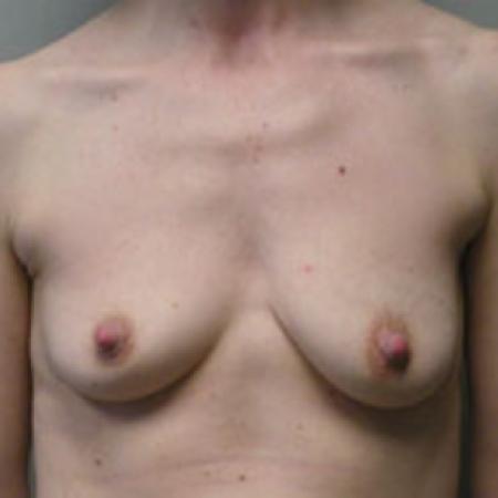 Before image 1 Case #121976 - Breast Augmentation Silicone 