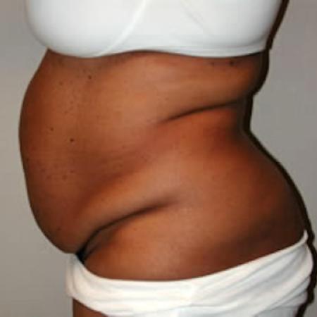 Before image 1 Case #122006 - Mommy Makeover Tummy Tuck