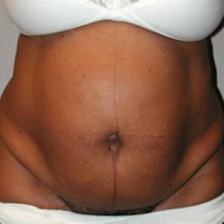 Before image 3 Case #122006 - Mommy Makeover Tummy Tuck