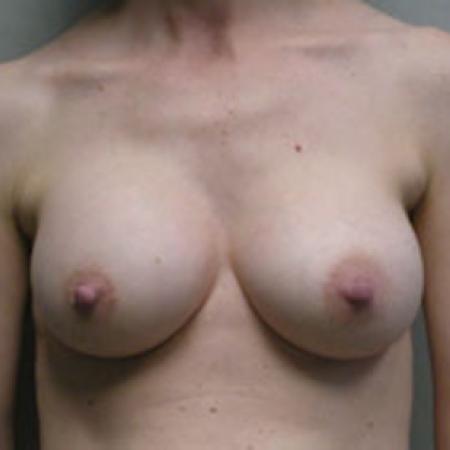 After image 1 Case #121976 - Breast Augmentation Silicone 