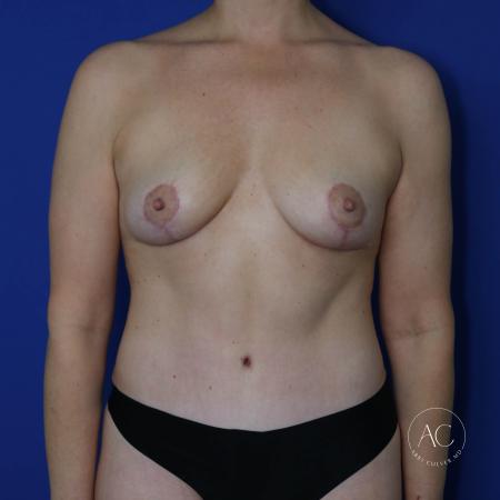 After image 1 Case #123166 - Breast lift with circumferential trunk liposuction
