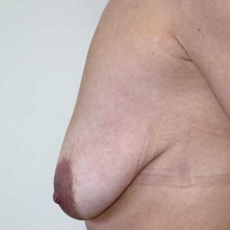 Before image 5 Case #122711 - Vertical Augmentation Mastopexy