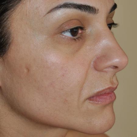 Before image 3 Case #122756 - Fat Transfer