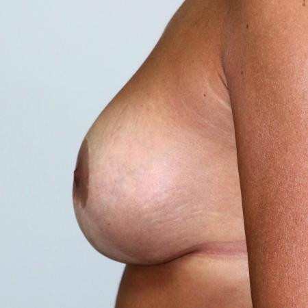 After image 5 Case #122711 - Vertical Augmentation Mastopexy