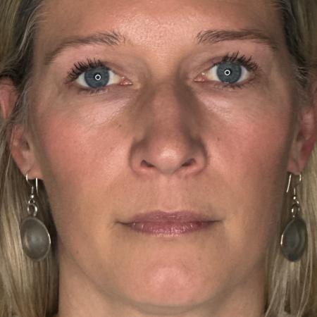 Before image 1 Case #122781 - rhinoplasty case