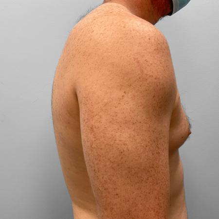 Before image 3 Case #123226 - Gynecomastia Correction
