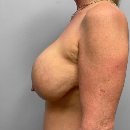 Before image 3 Case #123181 - Breast Lift and Implant Removal