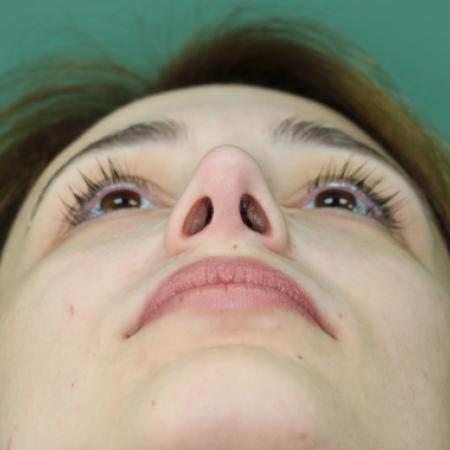 After image 6 Case #122881 - Deviation Syndrome. Rhinogenic Headache 