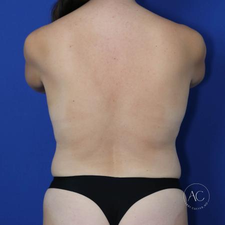 Before image 5 Case #123166 - Breast lift with circumferential trunk liposuction