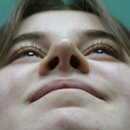 After image 6 Case #122866 - Nasal Deviation Syndrome