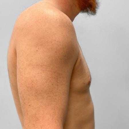 After image 3 Case #123226 - Gynecomastia Correction