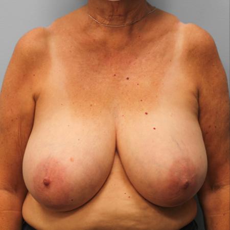 Before image 1 Case #123206 - Breast Reduction