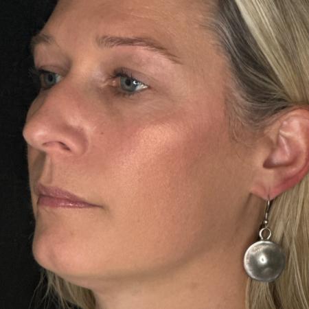 Before image 2 Case #122781 - rhinoplasty case