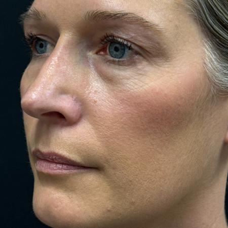 After image 2 Case #122781 - rhinoplasty case