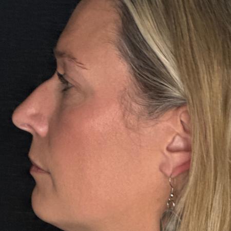 Before image 3 Case #122781 - rhinoplasty case