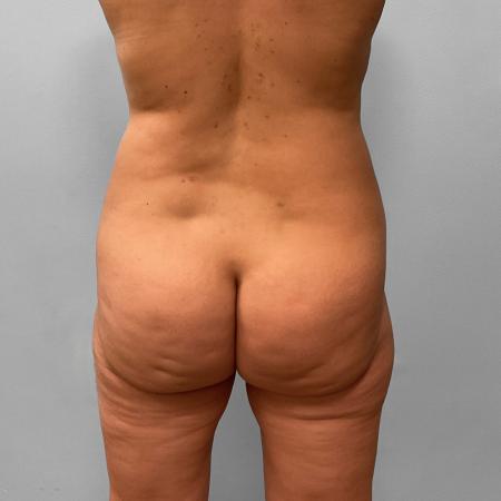 After image 3 Case #123191 - Liposuction