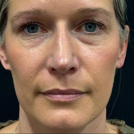 After image 1 Case #122781 - rhinoplasty case