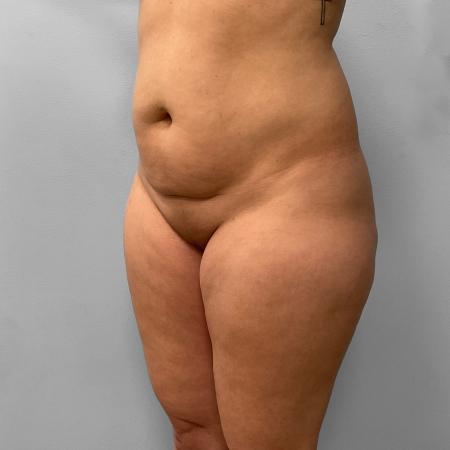 Before image 2 Case #123191 - Liposuction