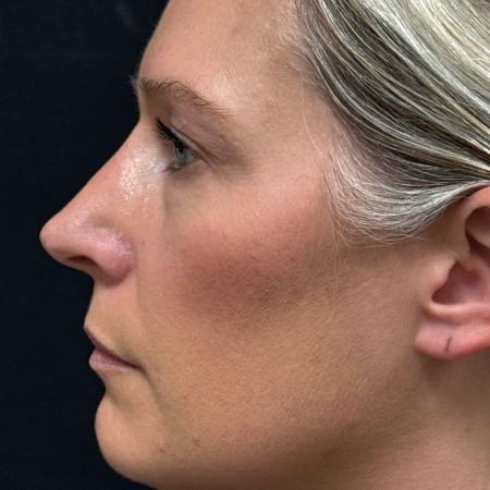 After image 3 Case #122781 - rhinoplasty case