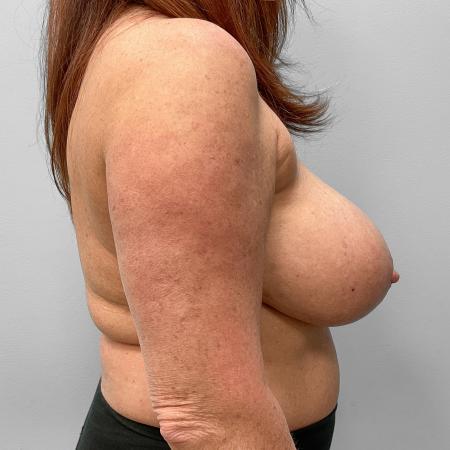 After image 3 Case #123501 - Breast Implant Exchange