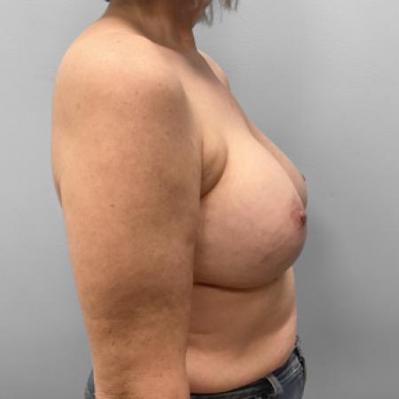 Before image 3 Case #123516 - Breast Implant Exchange