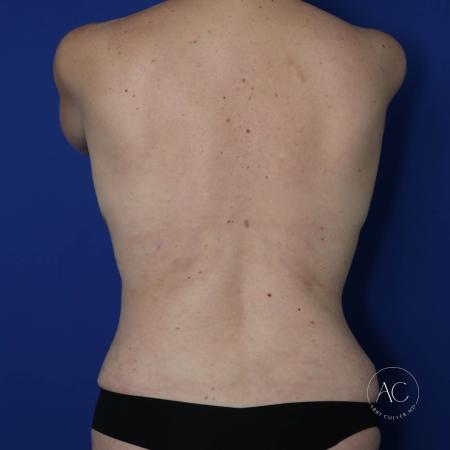 After image 5 Case #123546 - Breast augmentation, trunk lipo, abdominoplasty