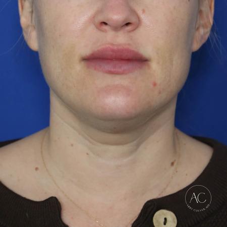 Before image 1 Case #124001 - Submental Liposuction