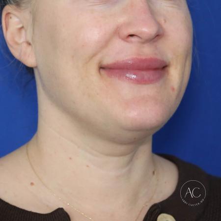 Before image 2 Case #124001 - Submental Liposuction