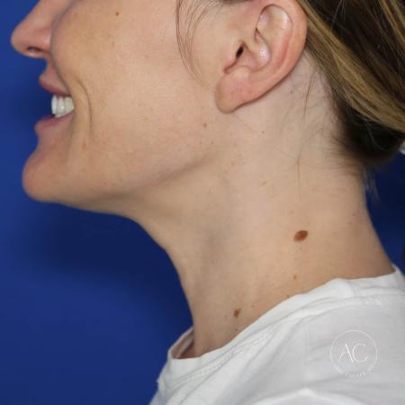 After image 3 Case #124001 - Submental Liposuction