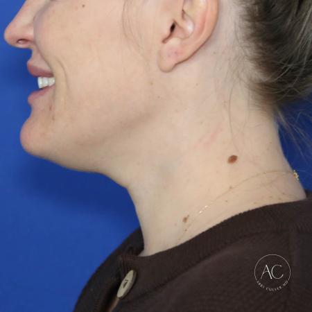 Before image 3 Case #124001 - Submental Liposuction