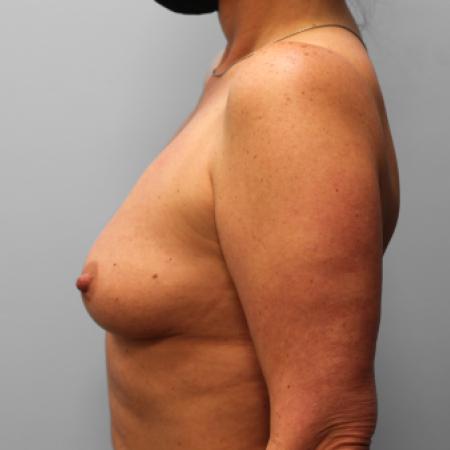 Before image 3 Case #123676 - Breast Augmentation
