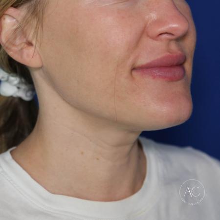 After image 2 Case #124001 - Submental Liposuction
