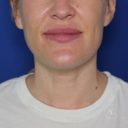 After image 1 Case #124001 - Submental Liposuction