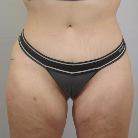After image 1 Case #124541 - Tummy tuck Patient #1578