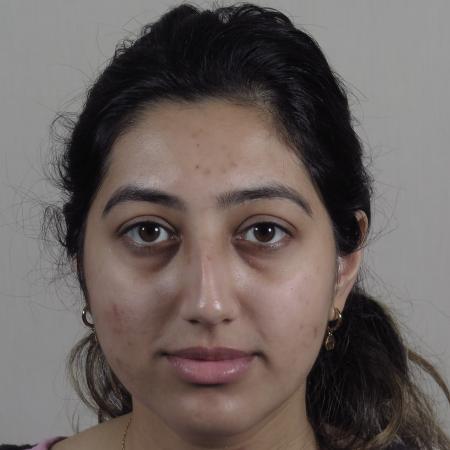 Before image 1 Case #124571 - Rhinoplasty Patient #1449