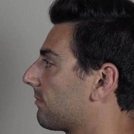 Before image 2 Case #124576 - Rhinoplasty Patient #1433