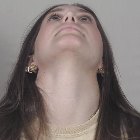 After image 3 Case #124566 - Rhinoplasty with chin augmentation Patient #1416 