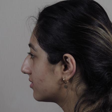 Before image 2 Case #124571 - Rhinoplasty Patient #1449