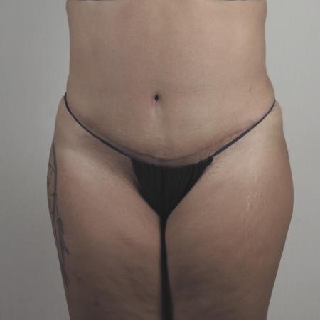 After image 1 Case #124536 - Tummy Tuck with Liposuction Patient #1482