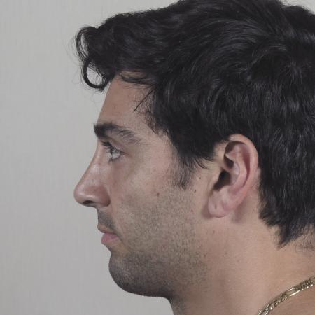 After image 2 Case #124576 - Rhinoplasty Patient #1433