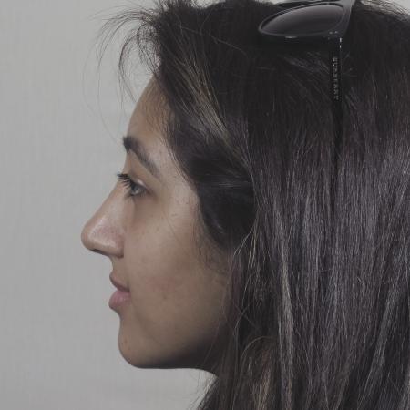 After image 2 Case #124571 - Rhinoplasty Patient #1449